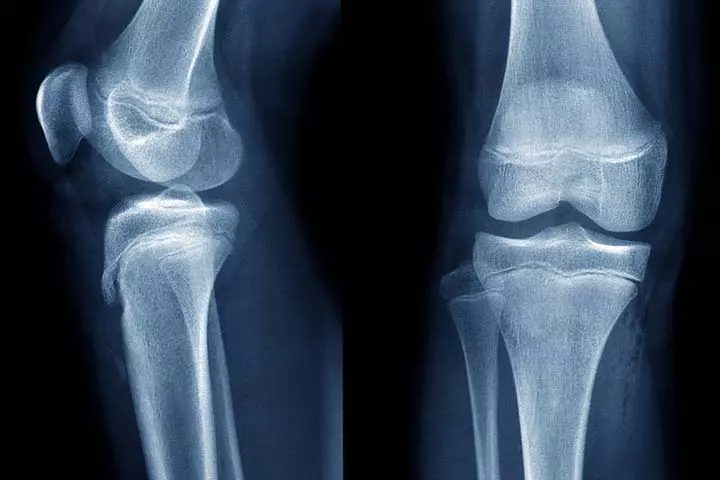 CT scans can detect bone deformities in a child