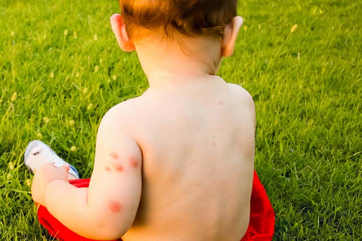 Calamine lotion helps in soothing insect bites