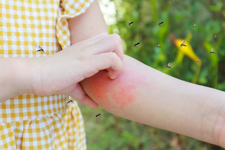 Call a doctor if itching due to mosquito bites in children get severe