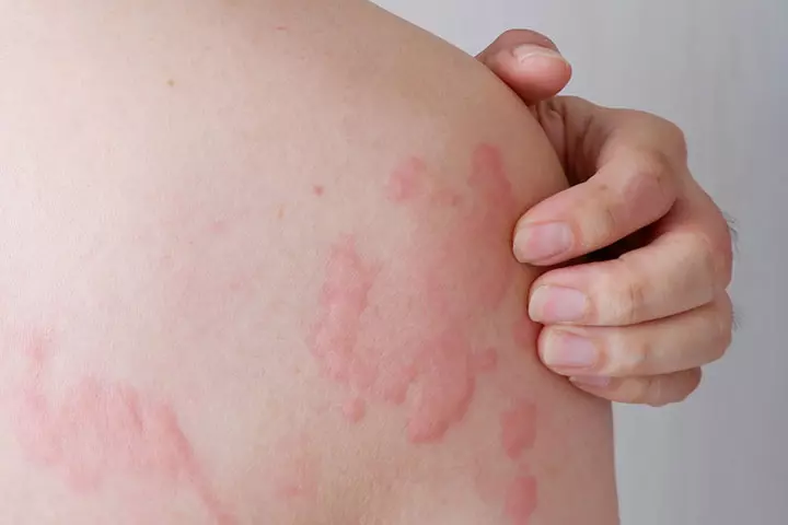 Causes of postpartum hives