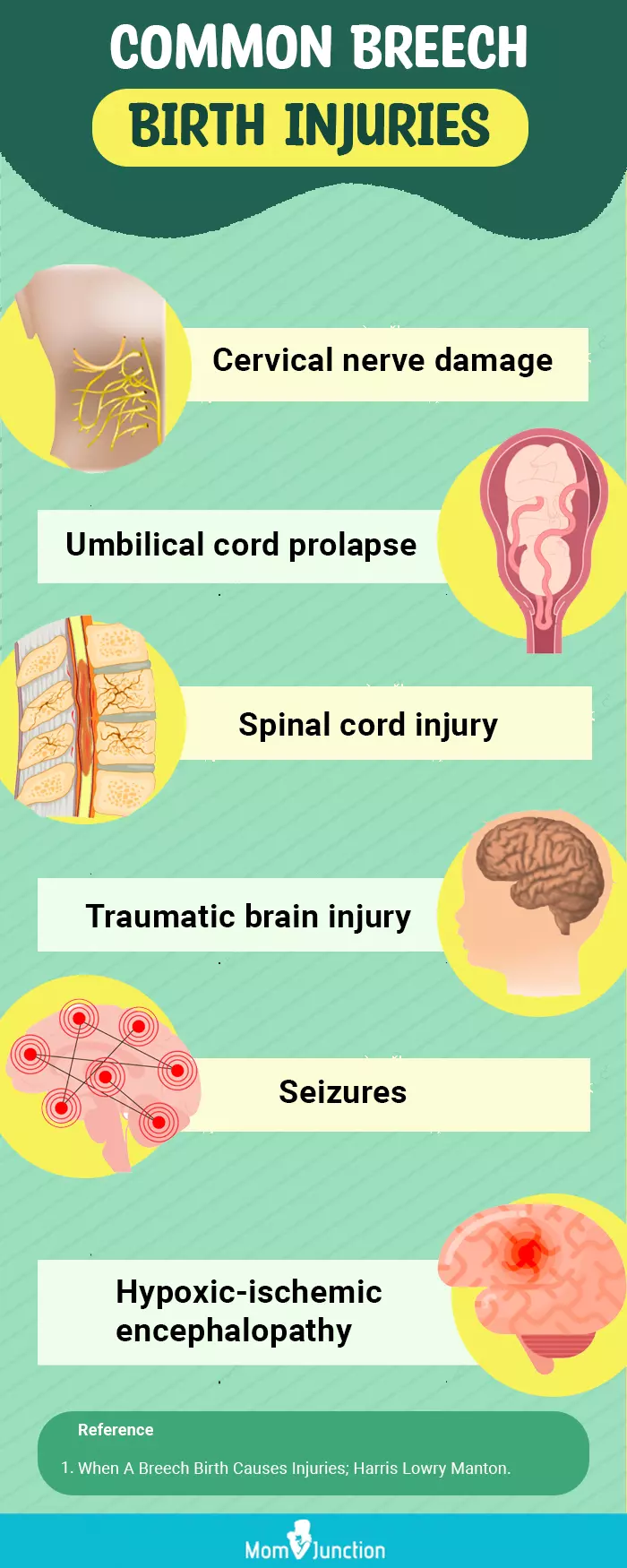 common breech birth injuries (infographic)