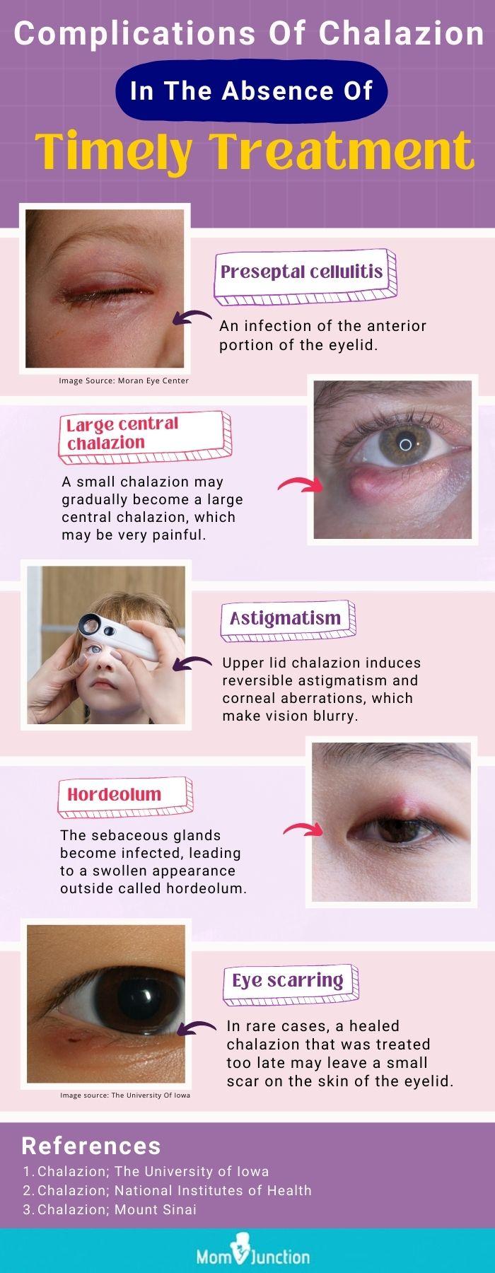 Eyelid Chalazion Treatment Chalazion Symptoms Causes Diagnosis 
