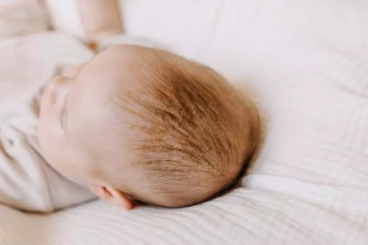 Cradle cap can cause baby dandruff