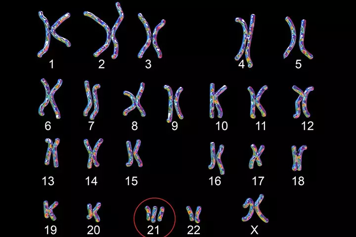 Down syndrome, a genetic disorder in children