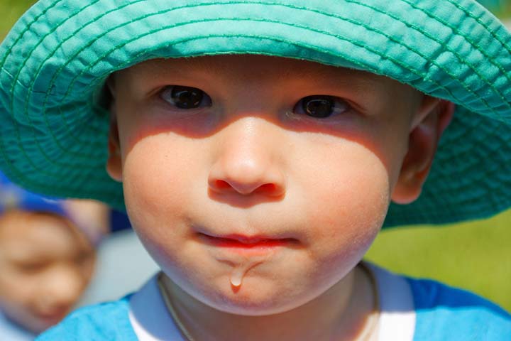 Drooling may cause toddler acne