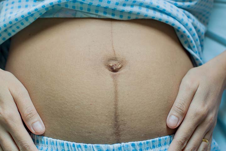 During pregnancy, the skin around the belly button becomes loose.