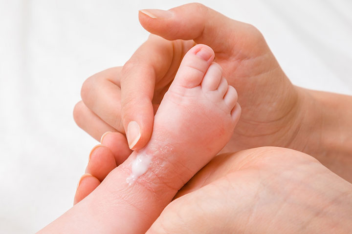 Eczema is a skin problem in babies 
