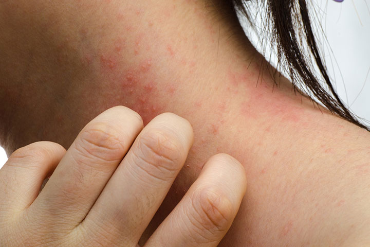 Eczema may appear like yeast infection