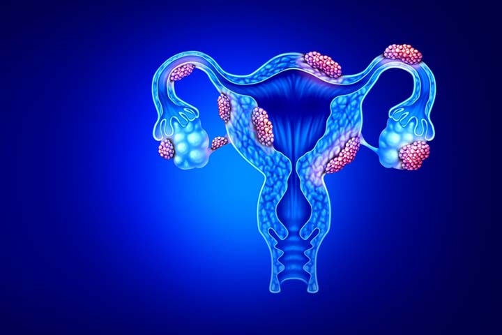 Endometriosis can be a risk factor for corpus luteam cyst.