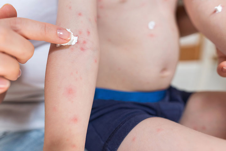 Eruption of blisters, Poison ivy rash on children