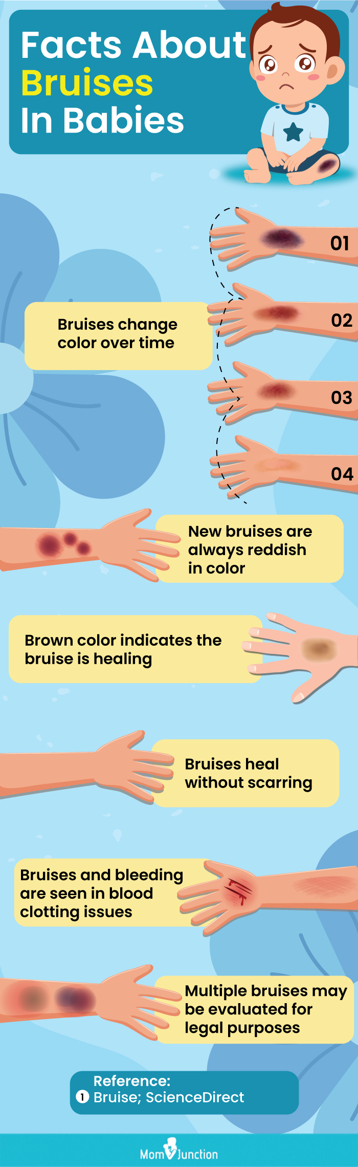 facts about bruises in babies (infographic)