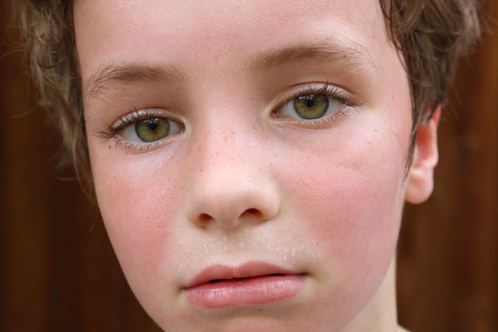 Flushed face can be a symptom of fever in children and teens