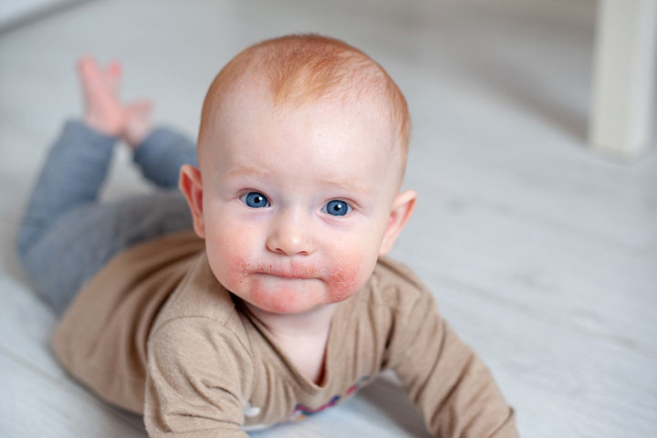 Food allergies can cause vomiting in babies