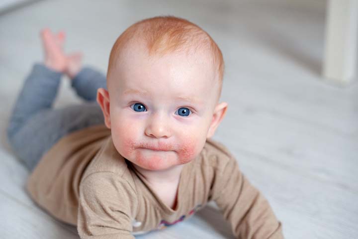 Food allergies in babies