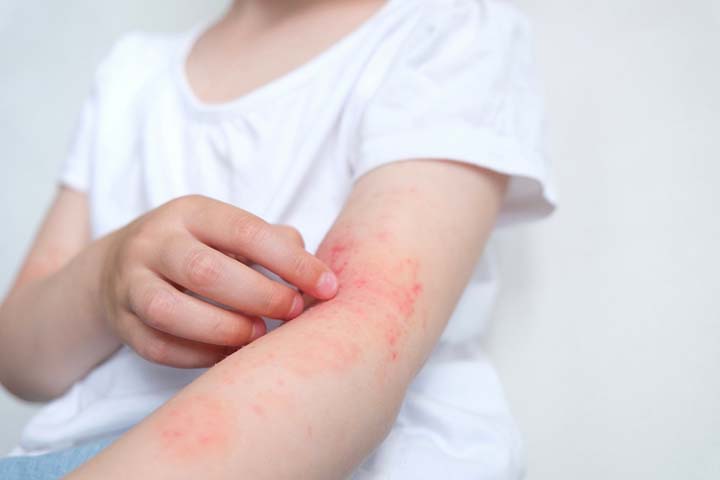 Fungal skin infections is a common disease in children