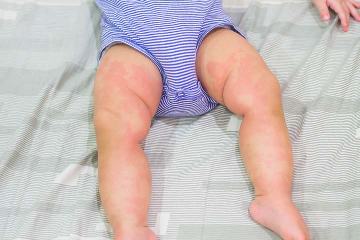 Gas drops may cause hives in some babies