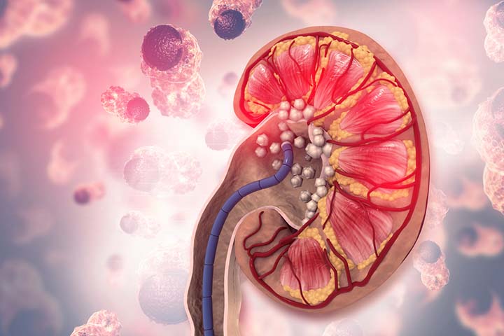 Hydrochlorothiazide effectively treats kidney stones