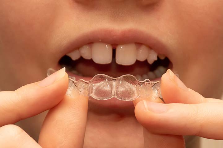 Invisalign帮助矫正儿童的龅牙。