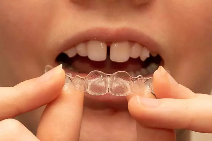 Invisalign помогает исправить кривые зубы у детей.