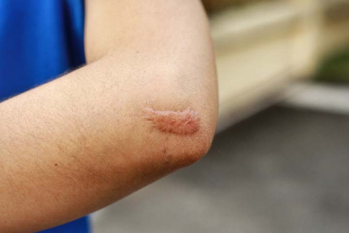 Keloids are a complication of burns in children