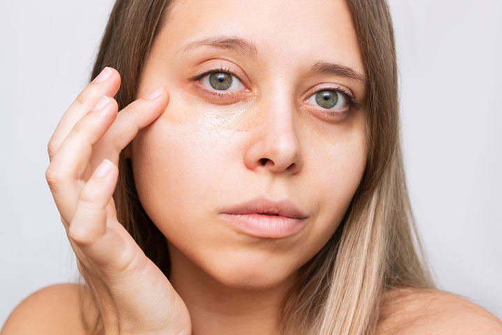 Lack of sleep post delivery can cause dark circles