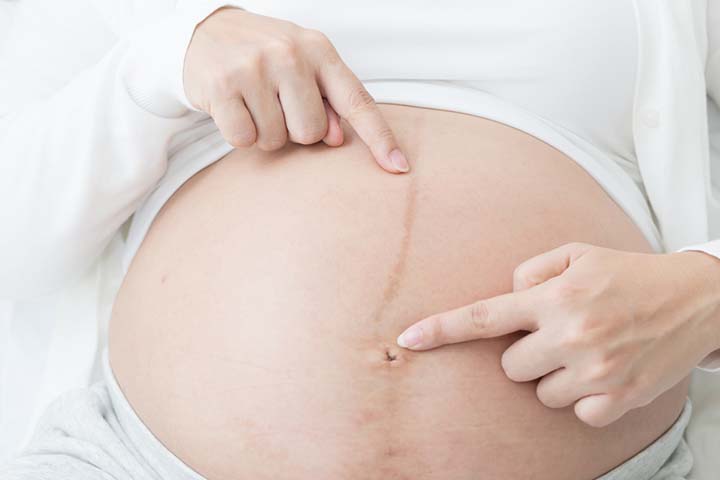 Linea nigra is a natural and harmless phenomenon during pregnancy