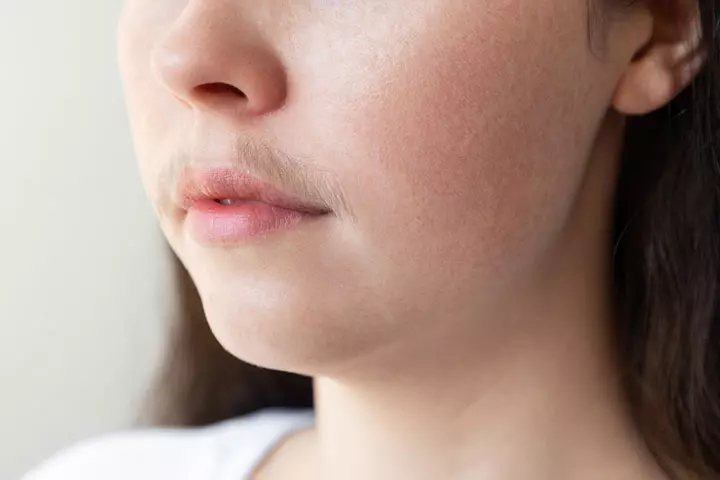 Excessive Facial Hair In Girls Causes And How To Get Rid Of It