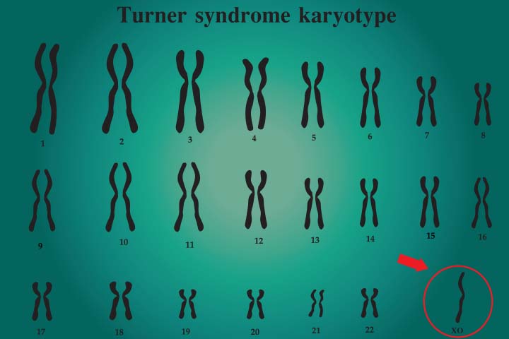 NIPT test can detect chromosomal sex conditions like Turner syndrome
