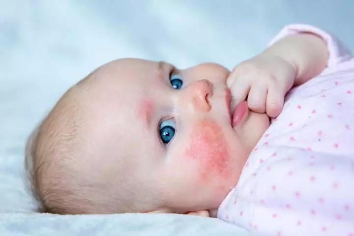 Not All Bumps Are Baby Acne