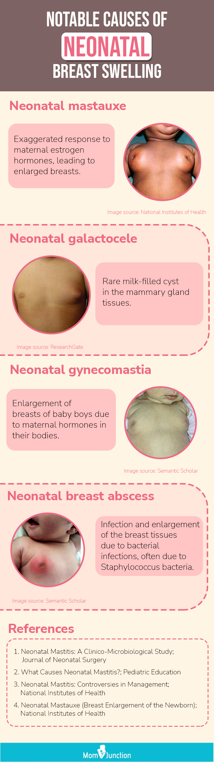 causes of breast swelling ln babies (infographic)