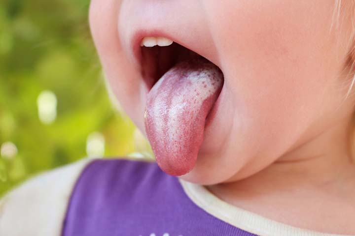 Oral thrush can be a sign of yeast infection