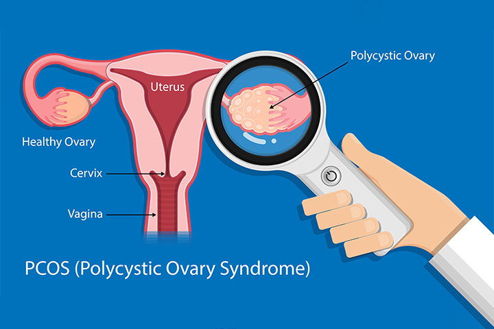 PCOS may cause disturbances or absence of ovulation