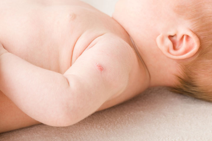 Painless vaccinations have low rates of swelling and redness