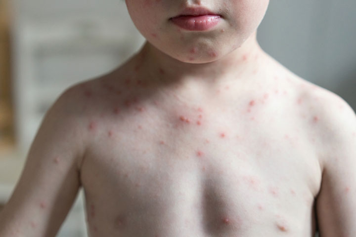 Pepto Bismol should be avoided during chicken pox in kids