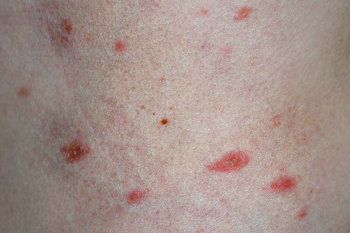 Pityriasis rosea in children usually starts as herald patch