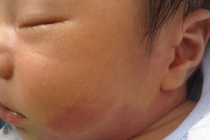 Port-wine stain birthmark in babies
