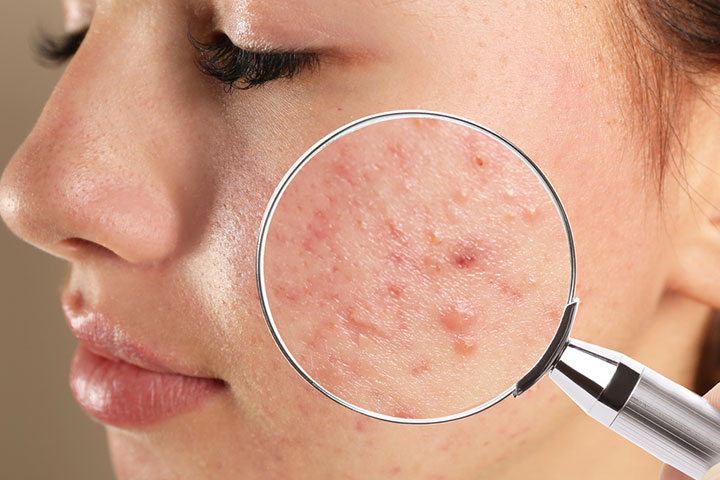Postpartum hormone changes may cause acne