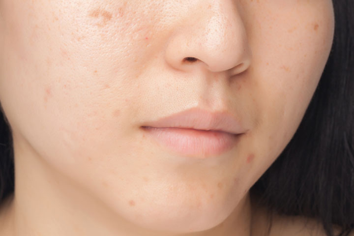 Postpartum skin care can help prevent acne