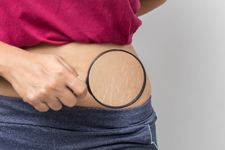 Rapid weight loss can cause stretch marks in teenagers