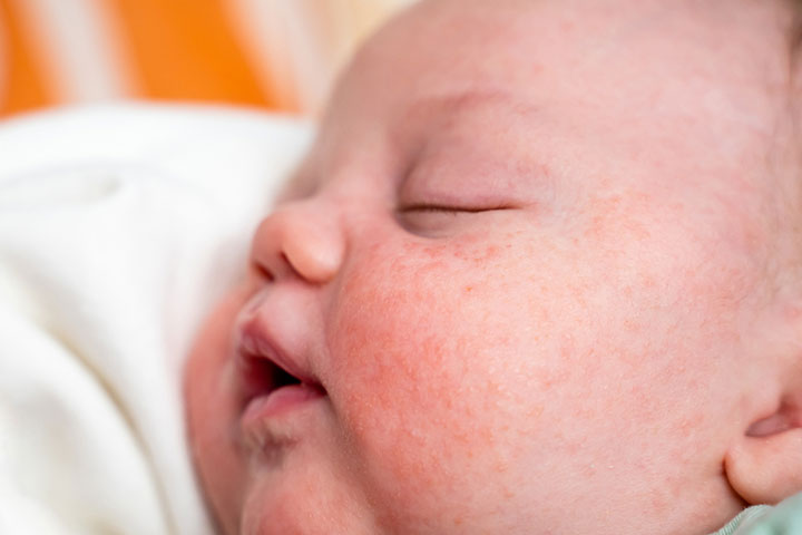 Rashes or hives is a sign of chocolate allergy in babies