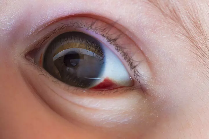 Redness in the baby's eye