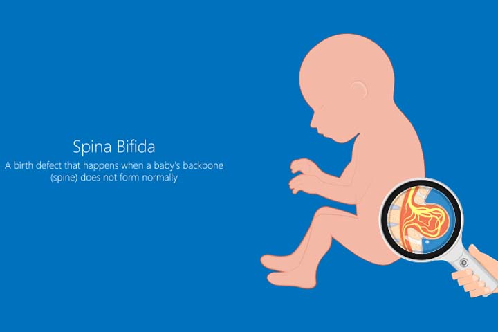 Sacral dimples may be associated with spina bifida 