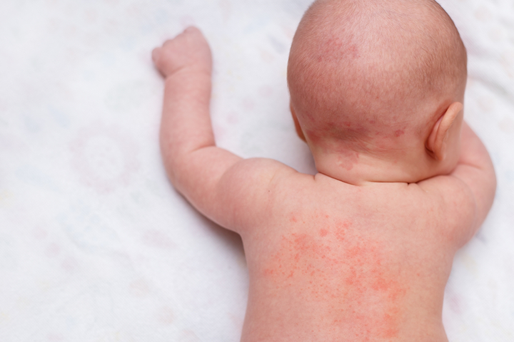 See a doctor if the baby develops skin rashes or blisters.