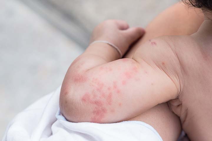 Skin rashes in baby is a symptom of nuts allergy
