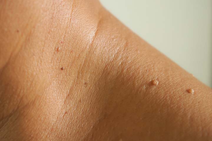 Skin tags often appear in clusters