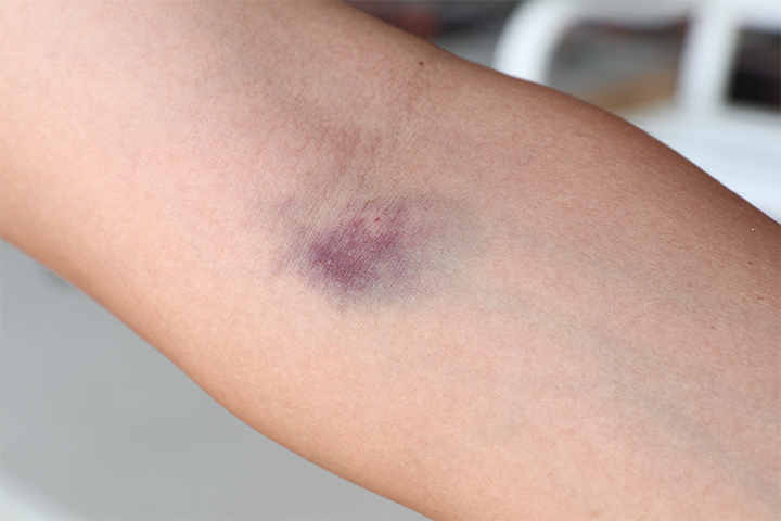 Some women may develop a hematoma after an hCG blood test