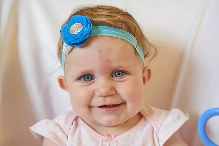 Stork bite birthmark in babies