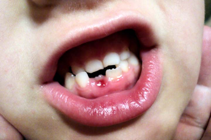 Swollen bleeding gum is a symptom of malnutrition in children