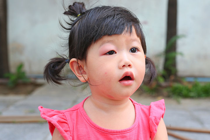 Swollen eyelids is a sign of ocular rosacea