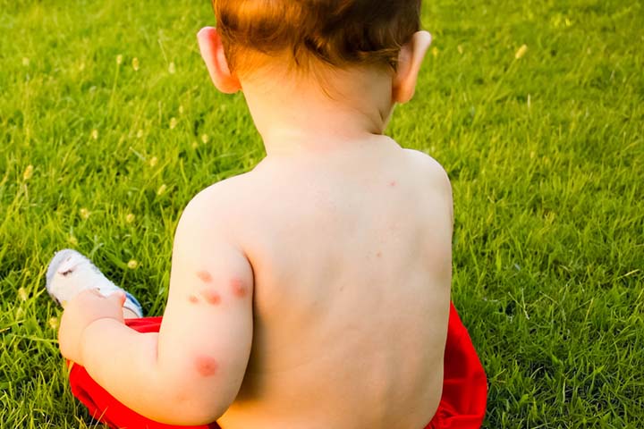 Symptoms of mosquito bites in babies